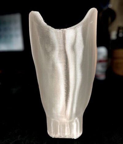 Clear test socket used during the lower extremity prosthetic fitting process