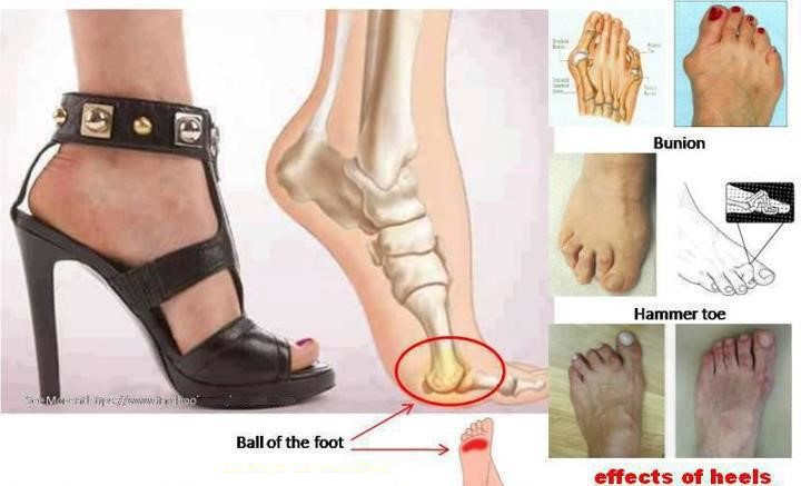 high heel effect on ball of foot