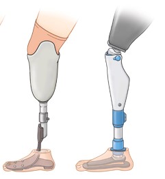 Preparatory prostheses